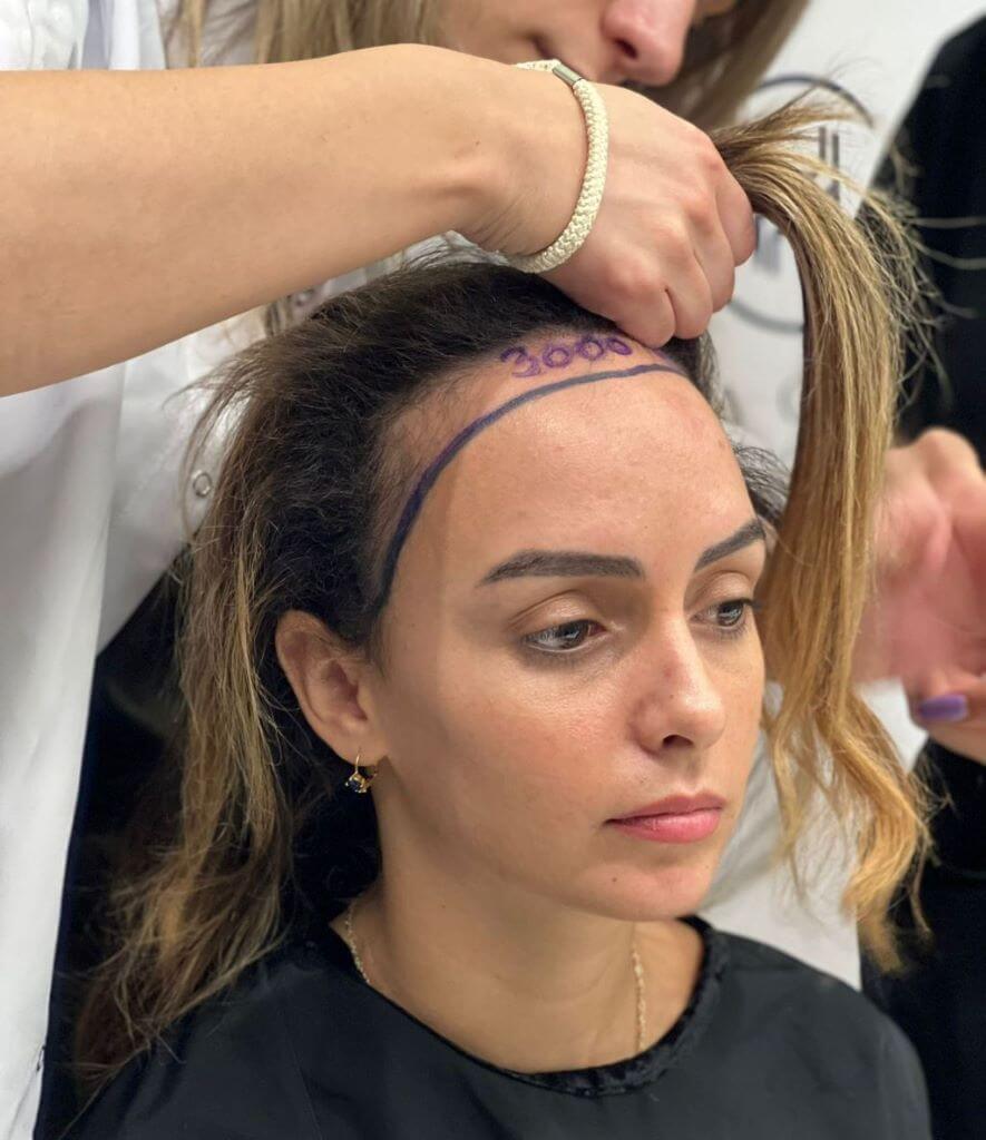 female-hair-transplant